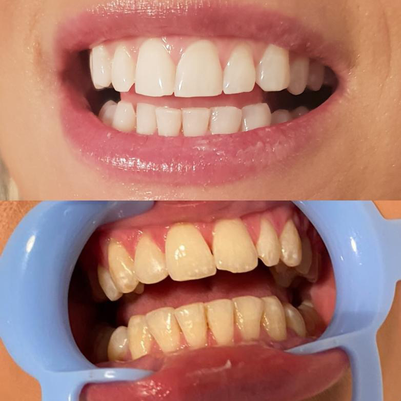 whitening teeth before after